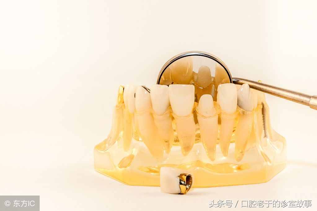 贵金属牙冠(贵金属牙冠优缺点)