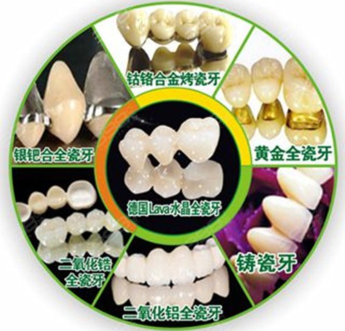 贵金属烤瓷(贵金属烤瓷牙是什么材质)