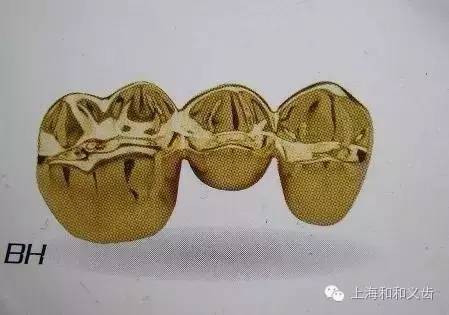 贵金属牙冠(贵金属牙冠有哪几种)
