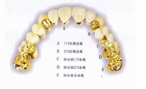 贵金属牙冠(贵金属牙冠和全瓷牙冠)