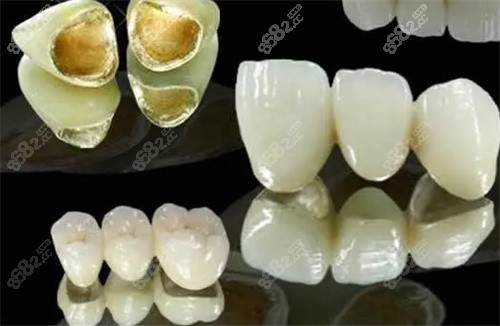 贵金属烤瓷牙多少钱(贵金属烤瓷牙多少钱一颗)