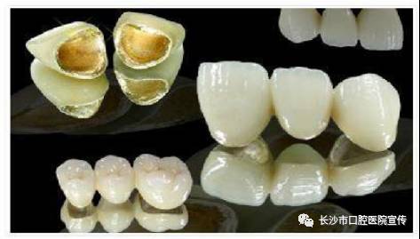 贵金属牙冠(贵金属牙冠是什么材质)