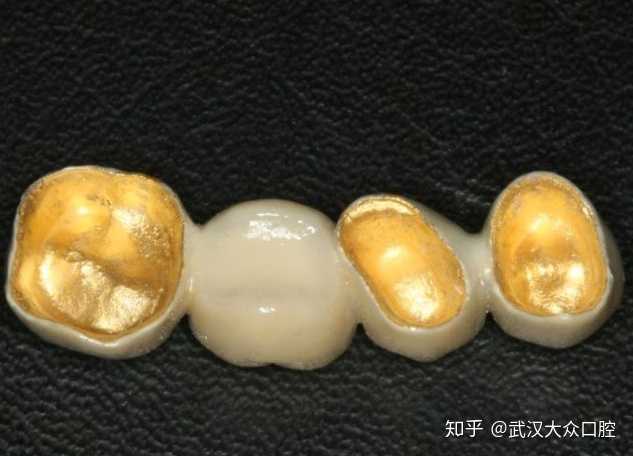 贵金属牙冠(贵金属牙冠和全瓷牙冠哪个好)