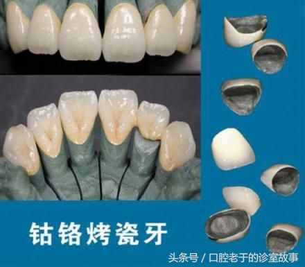 贵金属牙冠(贵金属牙冠可以做核磁共振吗)